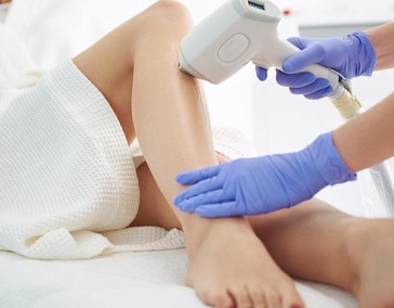 Лазерная эпиляция